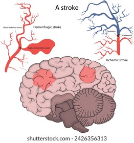 Vector illustration of a stroke. Hemorrhagic stroke and ischemic stroke of the brain.