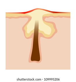 vector illustration: structure of pimple