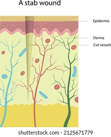 Vector Illustration Of The Structure Of A Stab Wound. Cut Vessels. Skin Injuries.