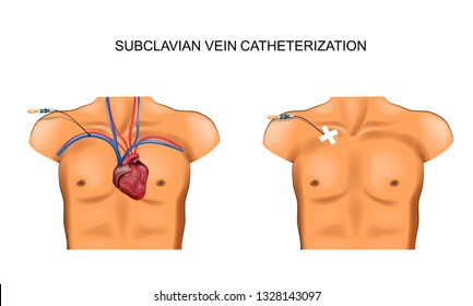 Vector Illustration Of Subclavian Vein Catheterization