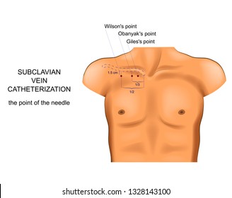 Vector Illustration Of Subclavian Vein Catheterization. Access Point