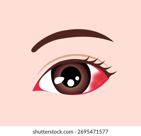 Ilustração vetorial de hemorragia subconjuntival