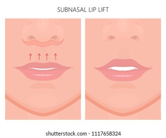 Vector illustration. Subnasal lip lift steps on women face, after procedure. Close up view. For advertising of medicinal, cosmetic and plastic surgery and procedures. EPS 10.