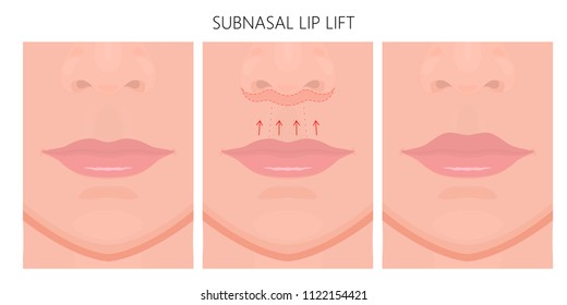 Vector illustration. Subnasal lip lift steps on women face, after procedure. Close up view. For advertising of medicinal, cosmetic and plastic surgery and procedures. EPS 10.