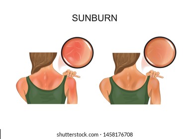 vector illustration of sunburn skin. tan on the girl s back