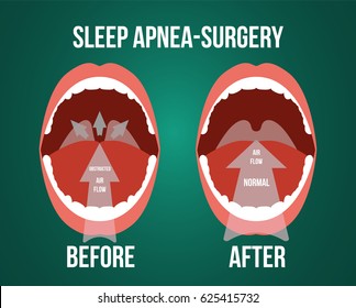 Vector Illustration Of Surgery For Obstructive Sleep Apnea, Before And After Result.