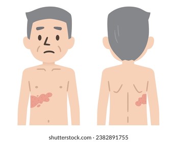 Vector illustration of the symptoms of shingles