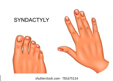 Vector Illustration Of Syndactyly. Webbed Hand And Foot
