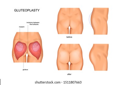 vector illustration of taut gluteal muscles. before and after treatments or fitness