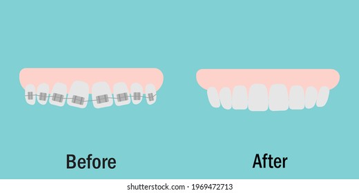 Vector illustration teeth before and after comparison braces orthodontic treatment .Dental braces concept on blue background.