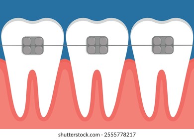 Vector illustration of teeth with braces.