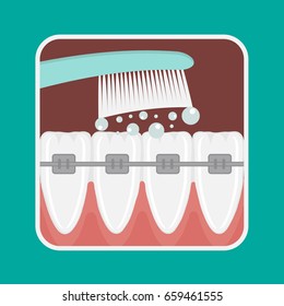 Vector illustration of teeth cleaning with braces. Toothbrush.
