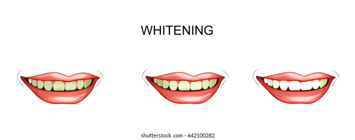 vector illustration of teeth whitening. cleaning plaque
