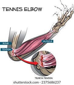 Vector illustration of Tennis elbow - tear in the common extensor tendon of the arm.