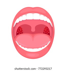  vector illustration of a throat bacterial and viral infection, tonsils inflammation.