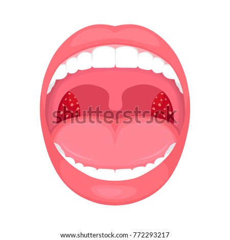  vector illustration of a throat bacterial and viral infection, tonsils inflammation.