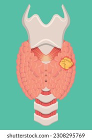 vector illustration of thyroid cancer isolated on blue background