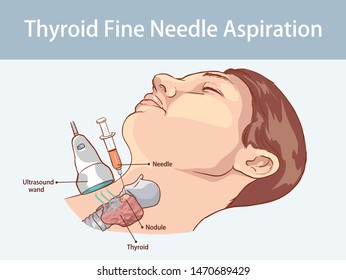  Vector illustration of a Thyroid fine needle aspiration