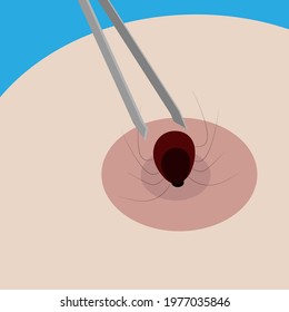 vector illustration of a tick bite. removing the tick with tweezers