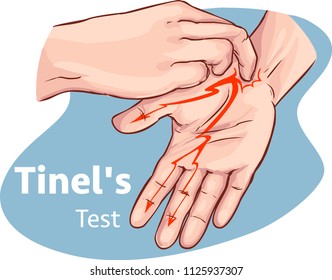  Vector illustration of a Tinel's test