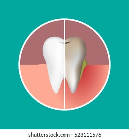 Vector illustration of a tooth before and after treatment. Sick and healthy tooth.