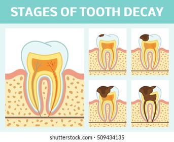 Vector illustration of tooth decay. Four stages of dental caries.