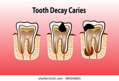 Vector illustration of tooth decay. Four stages of dental caries.