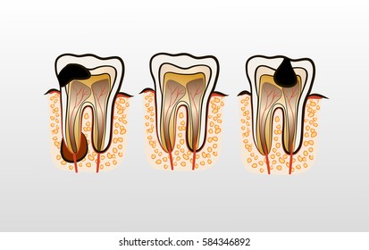 Vector illustration of tooth decay. Four stages of dental caries.