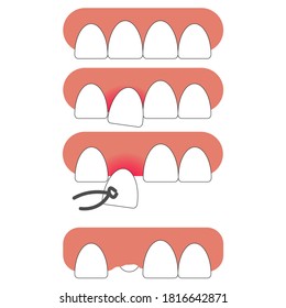 
vector illustration of tooth extraction with medical instrument on white background. The emergence of new tooth in place of the extracted one. new tooth came out.