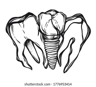 Vector illustration. Tooth and tooth implant on a metal pin, prosthetics, dentistry, print on t-shirt, line art style, tattoo, Handmade