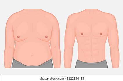 Vector illustration torso of a male before and after weight loss and sports. Front view. For medical publications and advertising of cosmetic, plastic procedures, stomach shunting, diet, sport. EPS 10