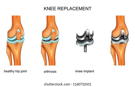 vector illustration of a total knee replacement