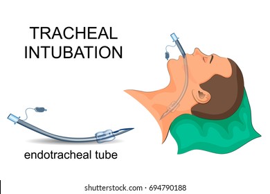 vector illustration of tracheal intubation. artificial ventilation of the lungs
