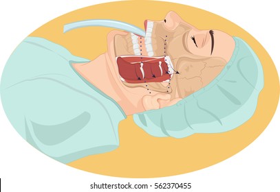 Vector Illustration Of Tracheal  Tube Anatomy