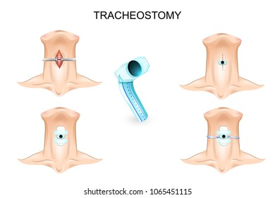 Vector illustration of tracheostomy. neck, tracheostomy tube