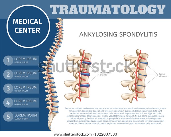 Vector Illustration Traumatology Medical Center.\
Flat Banner Ankylosing Spondylitis. Specializing Medical Journal\
for Surgeons. Introductory Colorful Booklet Medical Clinic for\
Treatment Spine.