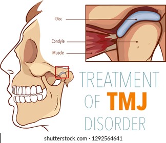 Vector illustration  of treatment of tmj disorder