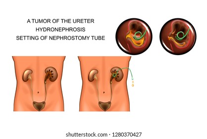 vector illustration of tumor of the ureter. hydronephrosis. setting of nephrostomy tube