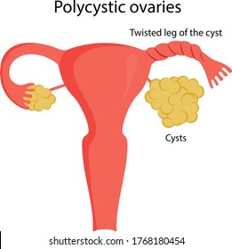 Vector illustration of twisted leg of the cyst. Ovarian diseases.