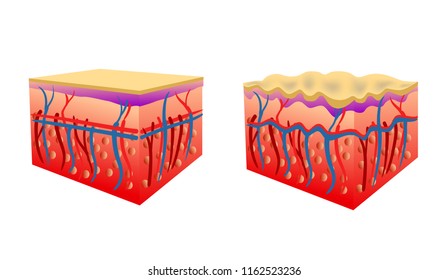Ilustración vectorial de dos tipos de piel que muestran celulitis