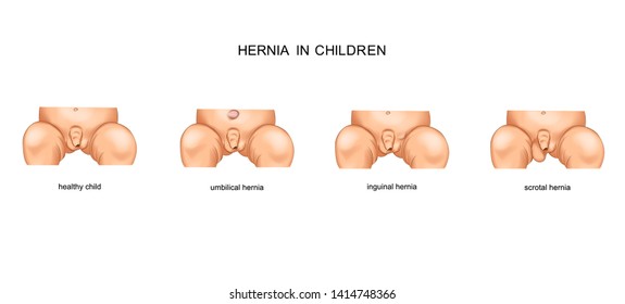 vector illustration of types of childrens hernia