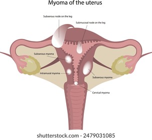 Ilustración vectorial de tipos de miomas. Mioma del útero. Enfermedad uterina.