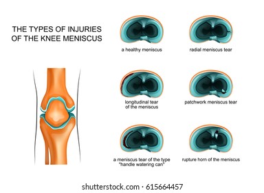 Vector Illustration Of The Types Of Meniscus Tear
