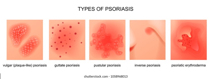 vector illustration of the types of psoriasis
