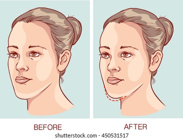 Vector Illustration Of A Underbite Jaw Surgery