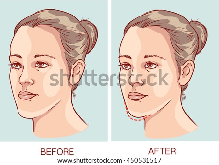 vector illustration of a Underbite Jaw surgery