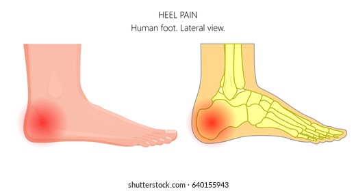 lateral heel pain