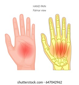 Vector illustration of unhealthy human hand with pain isolated on white background. Bony anatomy of the hand and wrist. Palmar view of the hand. For advertising and other medical publications. EPS 10.