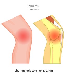 Vector illustration of unhealthy human knee joint with pain in the joint. Anatomy of the knee side, lateral view of the knee.  For advertising and other medical publications. EPS 10.