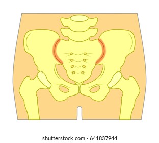 Vector illustration of unhealthy human pelvis with sacroiliac joint pain or injury.  For advertising and other medical publications. EPS 10